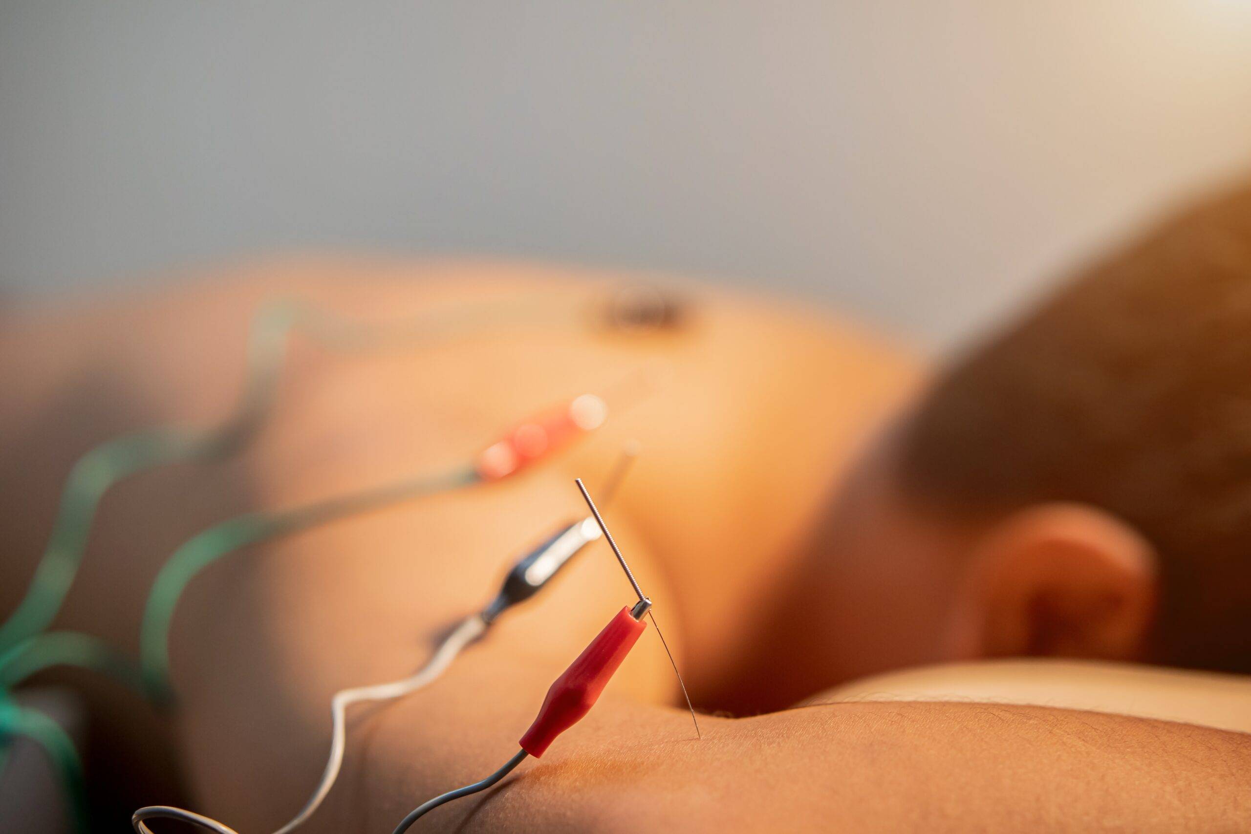 Electroacupuncture treatment Appleton Wisconsin